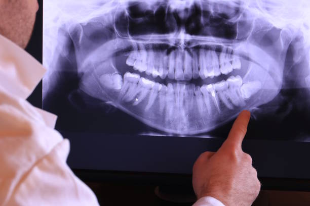 Best Emergency Root Canal Treatment in Keene, NH